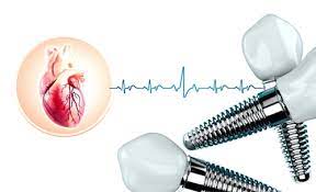 آیا کاشت ایمپلنت در بیماران قلبی با محدودیت همراه است؟ 3 آیا کاشت ایمپلنت در بیماران قلبی با محدودیت همراه است؟