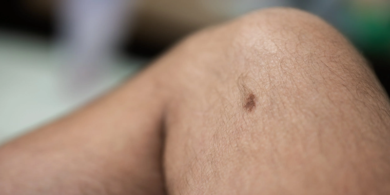 لکه قهوه ای روی پوست