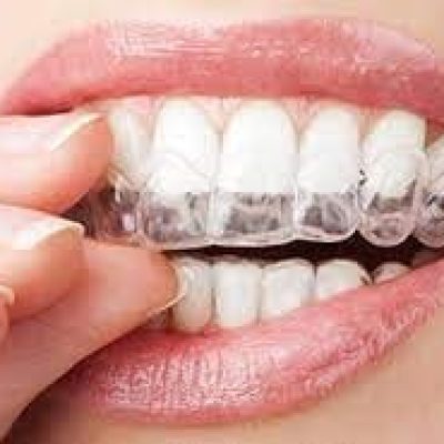 مقایسه بریس سنتی و الاینرهای نامرئی برای شروع درمان ارتودنسی