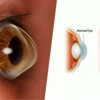 هوش مصنوعی می‌تواند به حفظ بینایی بیماران مبتلا به قوز قرنیه کمک کند