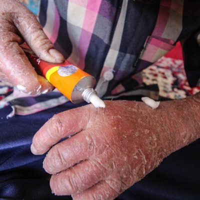 غرامت ۶۳۲ بیمار پروانهای واریز شد؛ ۴۸ پرونده نقص دارد