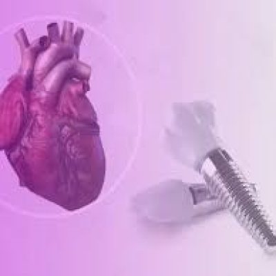آیا کاشت ایمپلنت در بیماران قلبی با محدودیت همراه است؟